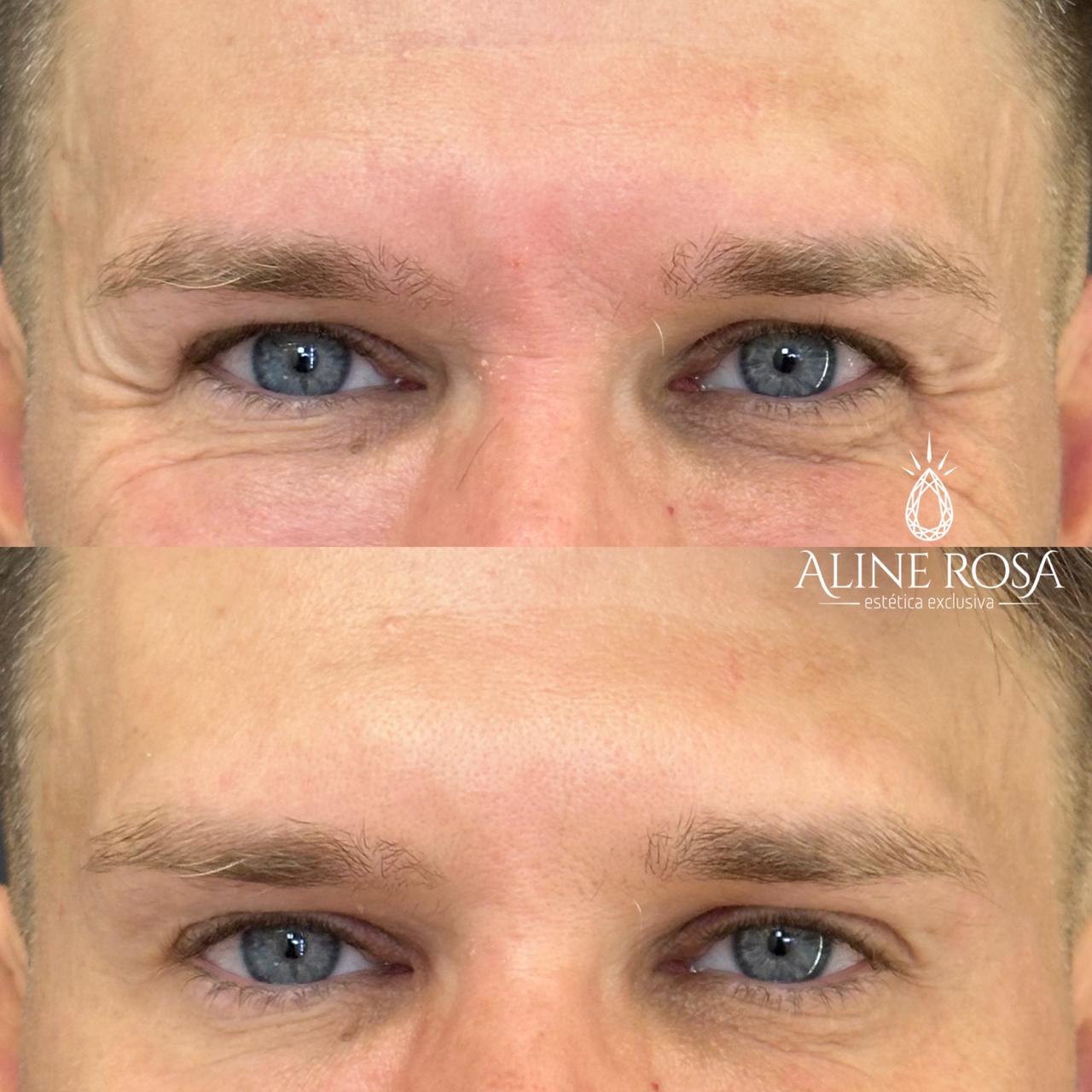 Botox Terço Superior Masculino